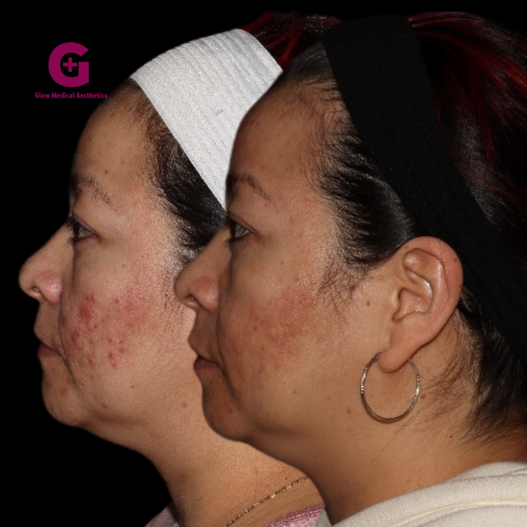 ACNE BOOTCAMP (1)