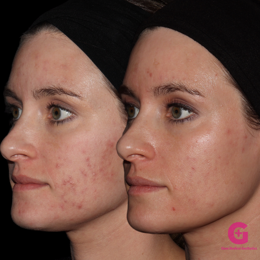 ACNE BOOTCAMP (2)