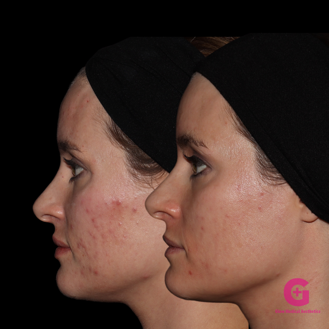 ACNE BOOTCAMP (3)