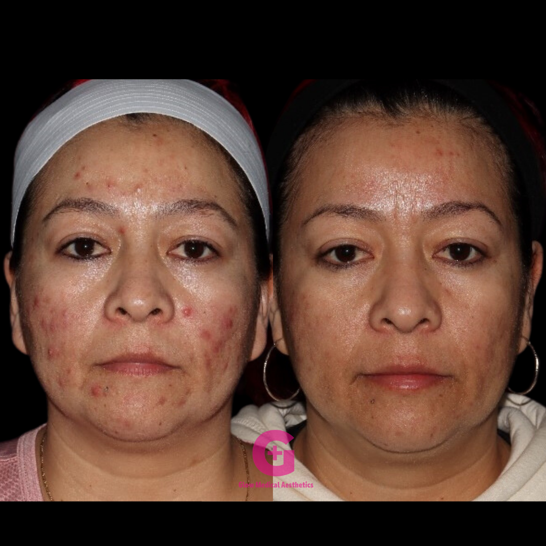 ACNE BOOTCAMP